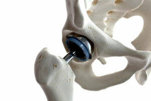 hip-replacement rendered in 3d against a white background