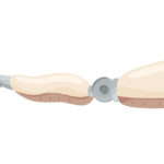 Above the elbow prosthesis arm illustration
