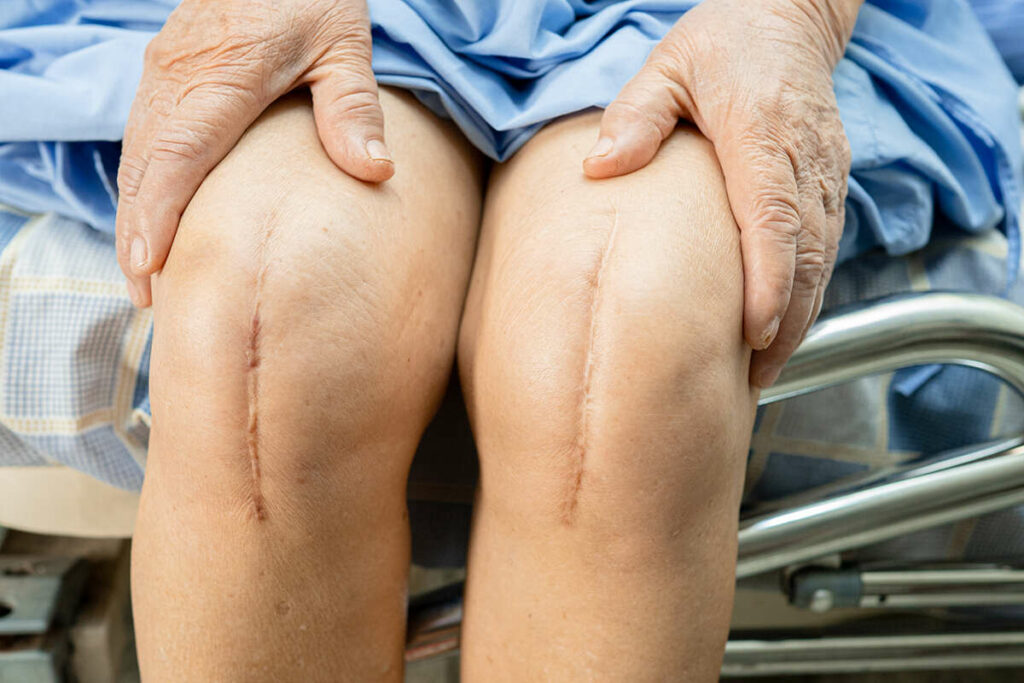 Person with scars on both knees after having a knee replacement surgery with prosthesis