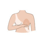 Breast prosthesis illustrated with woman holding a breast prosthesis silicone implant