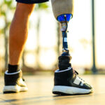 Person in a prosthetic leg with a vacuum suspension socket system