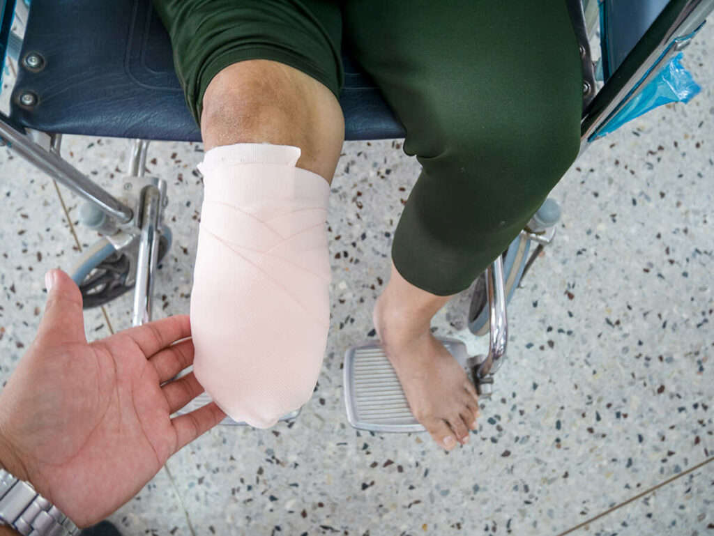 An amputated leg with bandage on of a person sitting in a wheelchair