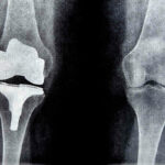 X-ray image of a knee replacement prosthesis