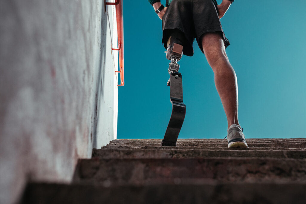 Can You Do Everything with a Prosthetic Leg – Getting Back to Normal Life