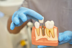 prosthetic teeth model