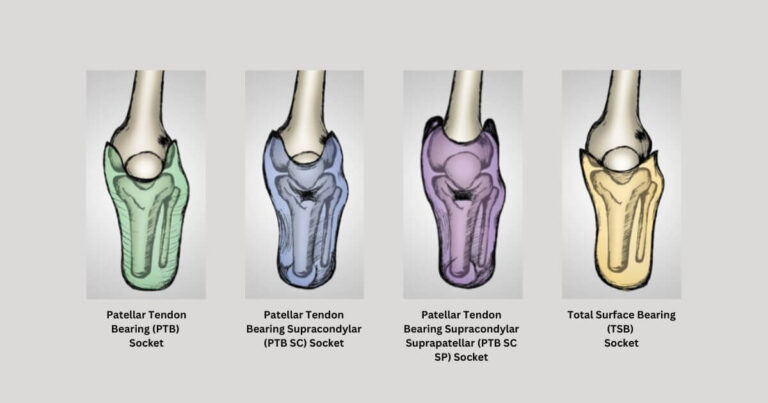 Prosthetic Socket Explained: Types, Process, Solutions and More