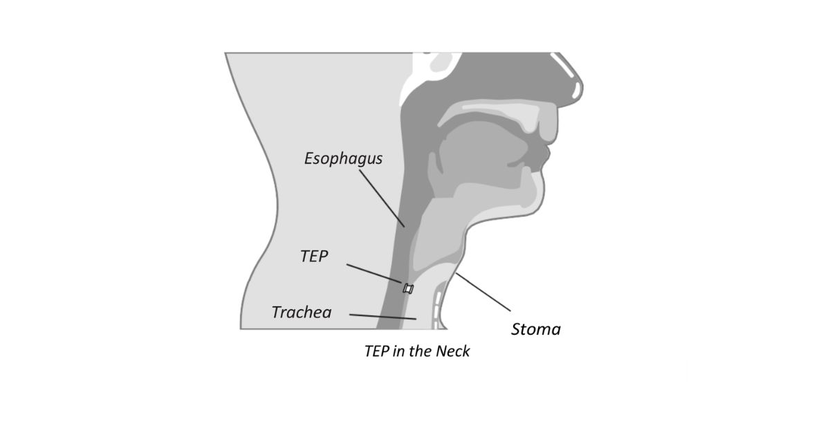 A diagram illustrating the anatomy of the neck with tracheoesophageal puncture (TEP) and stoma.