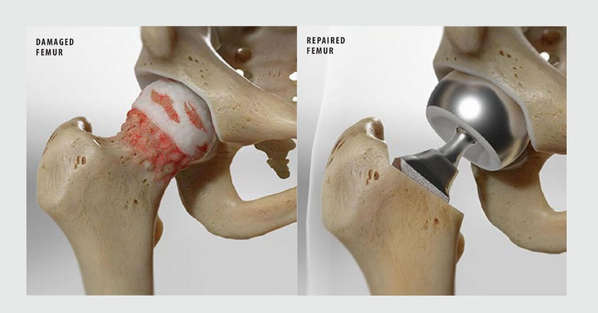 A comparison image showing a damaged femur on the left with visible wear, and a repaired femur on the right with a metal prosthetic femoral head inserted after bipolar hemiarthroplasty.