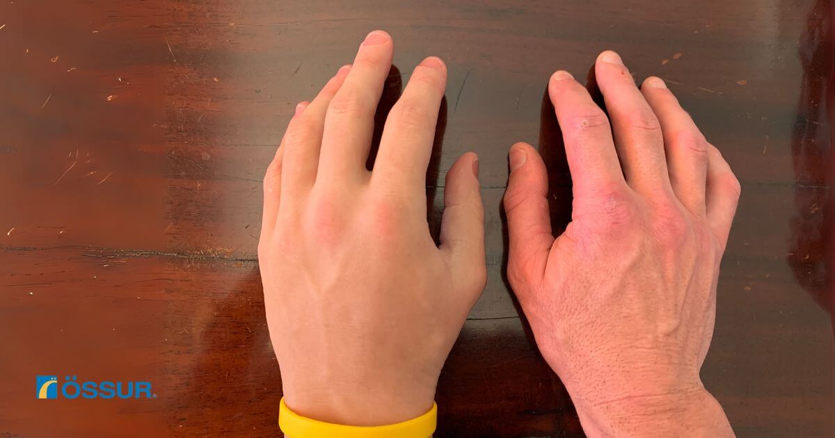 A comparison of Ossur Livingskin prosthetic hand and a natural hand placed side by side on a wooden table.