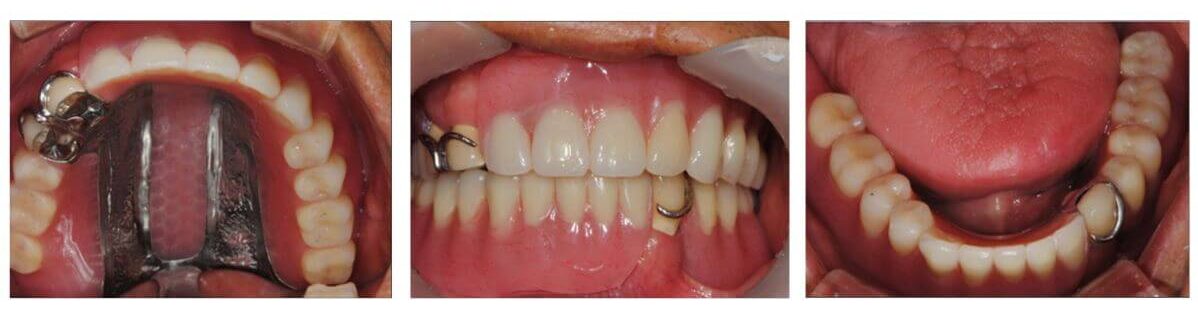 An intraoral view, close-up, and lower-angle view of a patient's mouth with a soft palate prosthesis in place