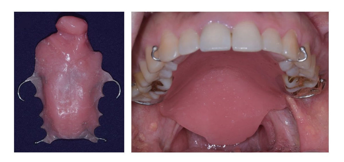 Removed palatal obturator and intraoral view of the prosthesis in place