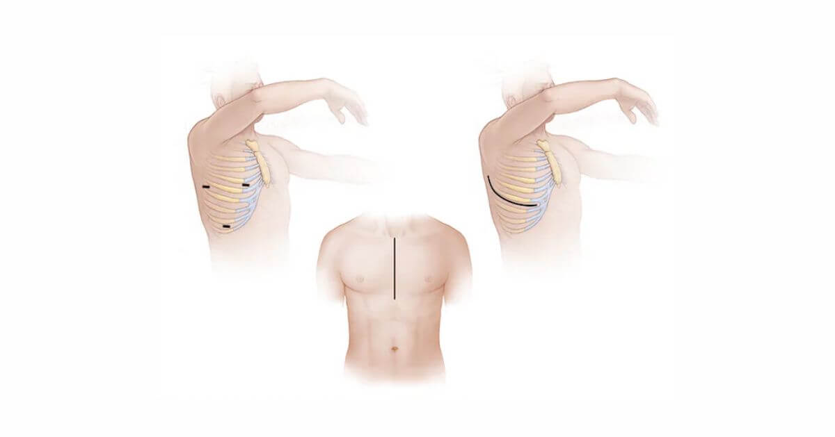 Illustration showing surgical incision sites for heart valve surgery, including open-heart and minimally invasive options.