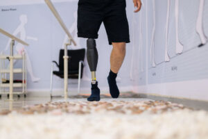 Person walking with a knee disarticulation prosthesis while using a support bar for stability during rehabilitation.