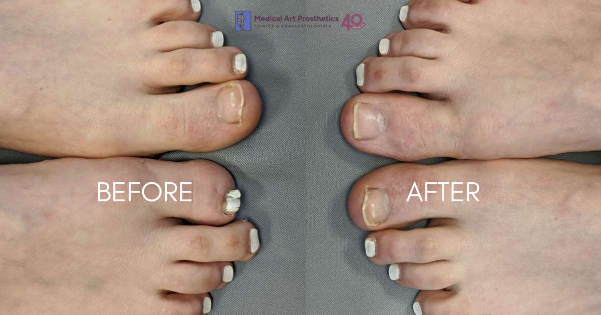 Medical Art Prosthetics Custom Toe Before and After