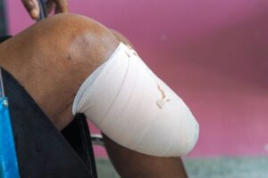 Person with a below-knee amputation sitting in a wheelchair with a bandaged residual limb after surgery.