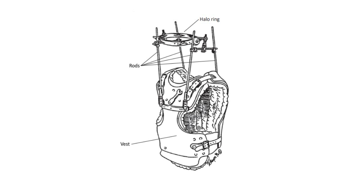 Diagram showing the parts of a halo brace including the halo ring, support rods, and chest vest