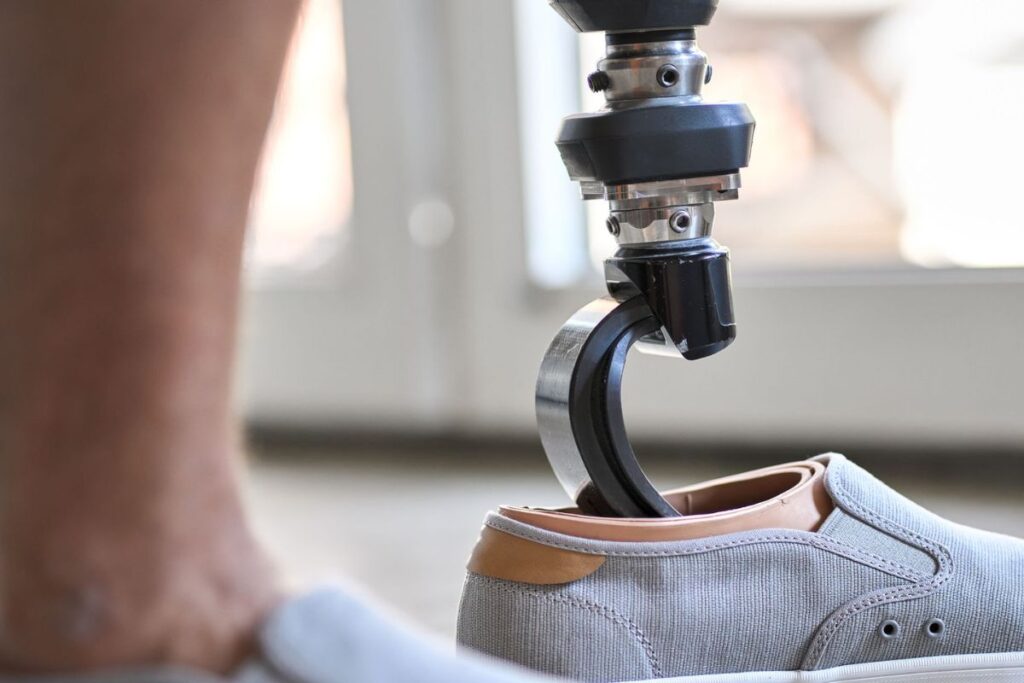 Close-up of a prosthetic foot being fitted into a gray shoe during prosthetic care.
